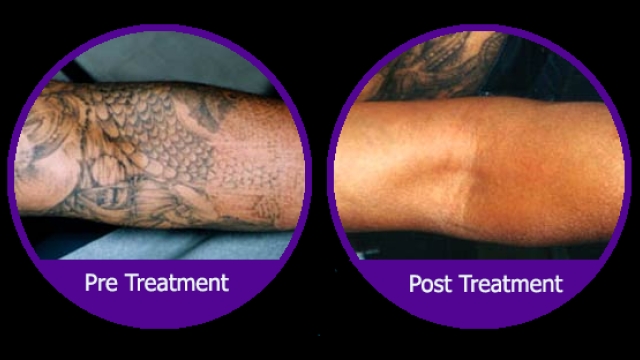 Tattoo Laser Removal –  3 Reasons Why Your Tattoo May Want To Go!