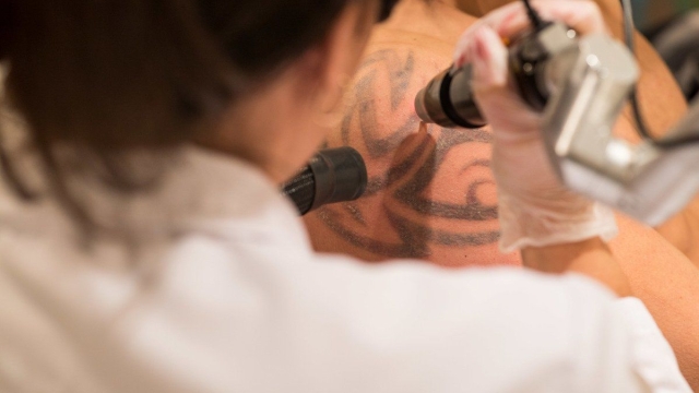 How Is It Possible To Remove A Tattoo Safely?
