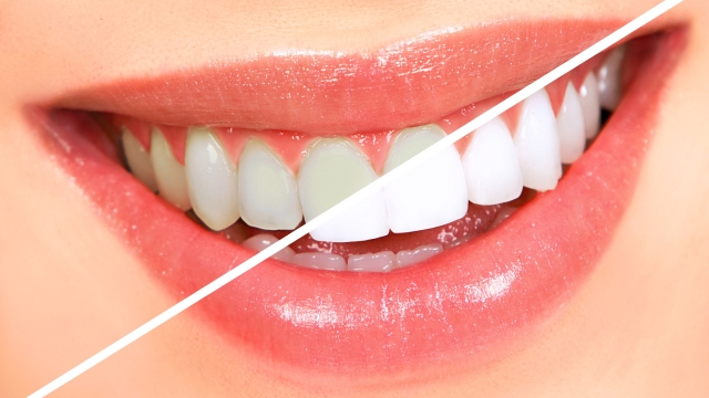 Unveiling Picture-Perfect Smiles: The Magic of Crest Whitening Strips