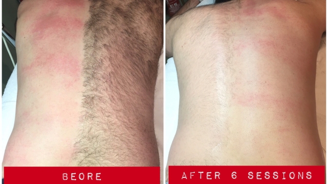 Silky Smooth for Life: Unveiling the Magic of Laser Hair Removal